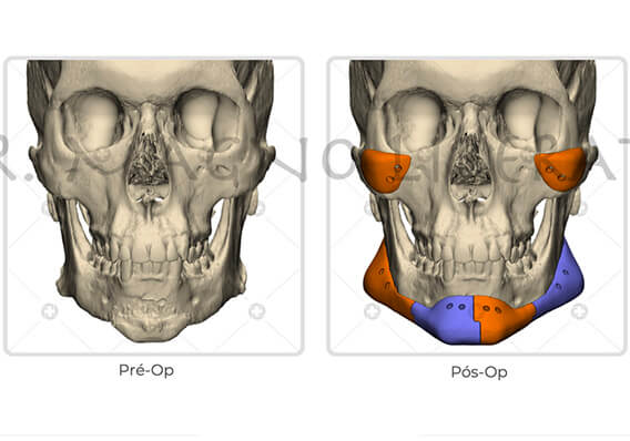 Harmonização Facial Permanente com Próteses Impressas em 3D