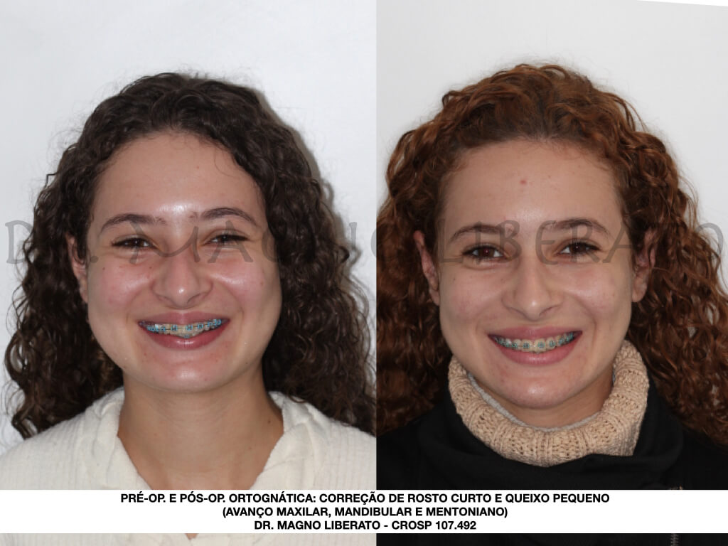 Cirurgia de mandíbula - Consulta Ideal